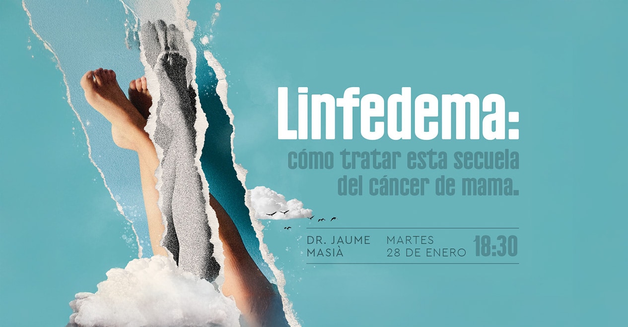 Linfedema: cómo tratar esta secuela del cáncer de mama